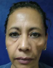 Fotografía frontal de una mujer de mediana edad con asimetría facial evidente: la hemicara derecha de la paciente muestra aplanamiento y depresión de la región malar y temporal, con hundimiento periorbitario asimétrico y desplazamiento del contorno respecto al lado contralateral, que conserva volumen. La asimetría es de volumen y de contorno, no de expresión: la musculatura se mueve, lo que falta es el tejido que hay debajo. Serdev, Advanced Techniques in Liposuction and Fat Transfer, figura 9.